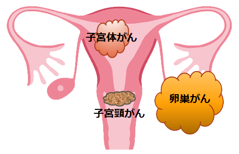 子宮がん　婦人科
