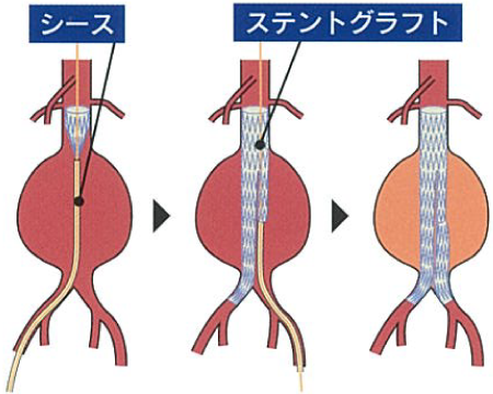 腹部大動脈瘤に対するステントグラフト内挿術