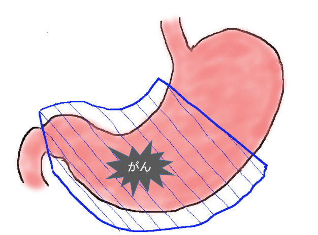 胃の下部に発生した胃がん手術