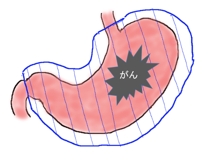 胃の上部に発生した胃がんや大きな胃がん