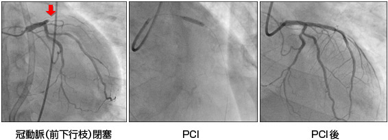 冠動脈（前下行枝）閉塞・PCI・PCI後