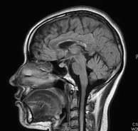 脳のMRI画像