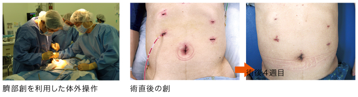 外科　腹腔鏡手術　例