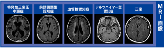 MRI画像