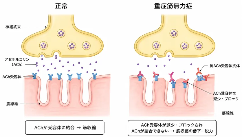 正常な神経筋接合部と重症筋無力症における神経筋接合部の模式図